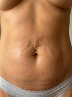 Close-up of a person's torso with a visible belly button loose skin and strech marks improve after wearing glouren red light therapy belt