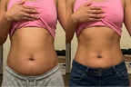Before and after comparison of a person's waistline over 30 days, showing more toned stomach from Glouren red light therapy belt.