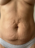 Close-up of a person's abdomen with visible skin texture and stretch marks before using Glouren red light therapy belt.